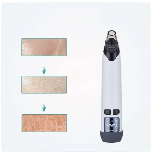 Blackhead Vacuum before and after pores
